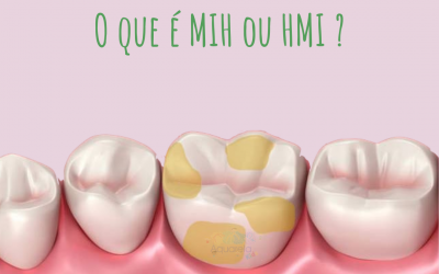 MIH ou HMI – Hipomineralização dos Molares e Incisivos