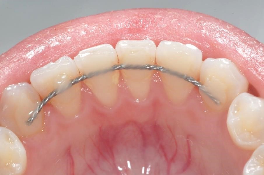 Preciso usar contenção depois do tratamento ortodôntico?