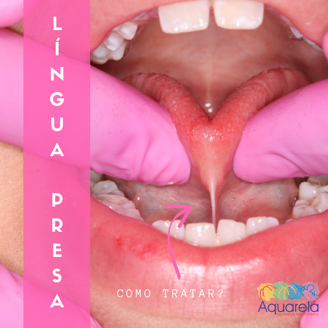 Língua presa, como tratar?