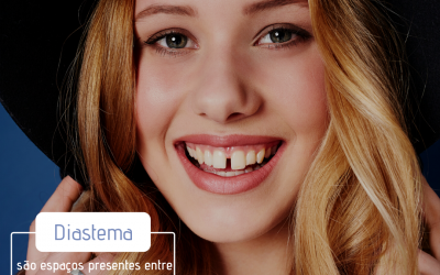 Diastemas