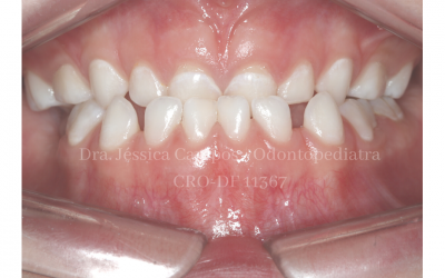 Classe III em crianças