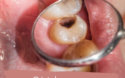 Cárie, saiba como evitar!