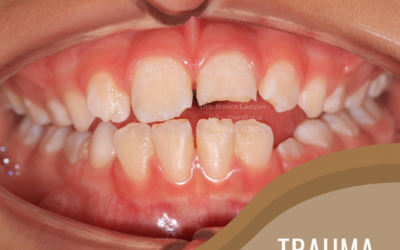 Trauma Dentário