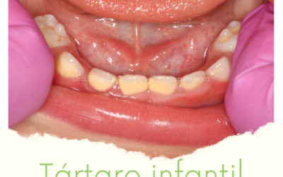 Tártaro Infantil