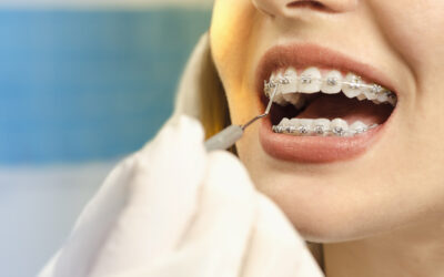 Você já teve recidiva ortodôntica após o fim de um tratamento com aparelho?