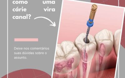 Como uma cárie vira canal?