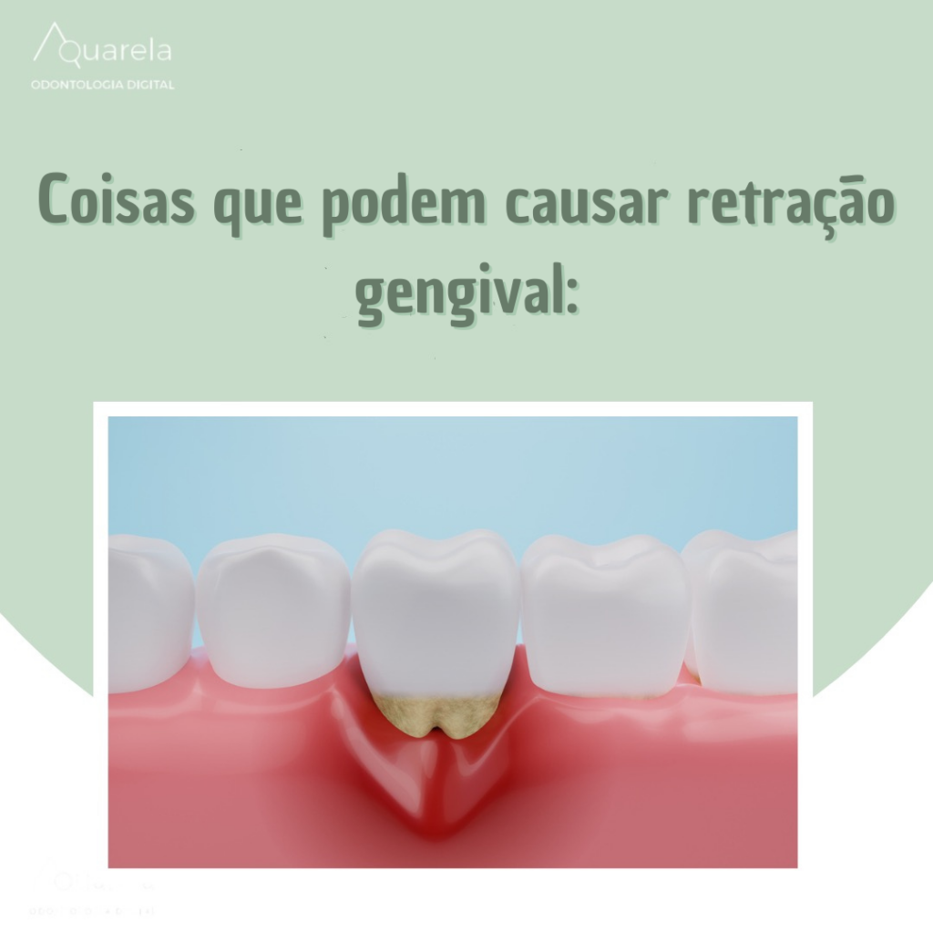Retração gengival - Aquarela Odontologia Brasília