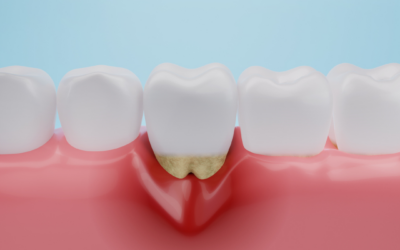 Coisas que podem causar a retração gengival