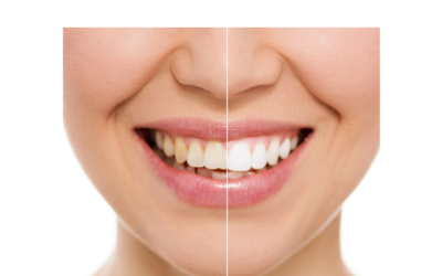 Métodos de clareamento dental