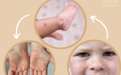Lesão mão pé e boca