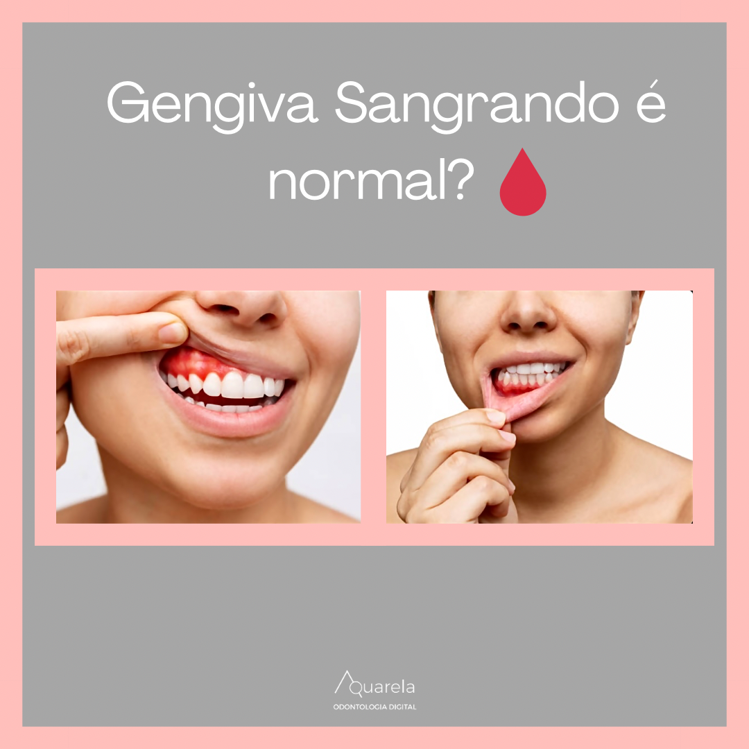 Gengiva sangrar é normal?